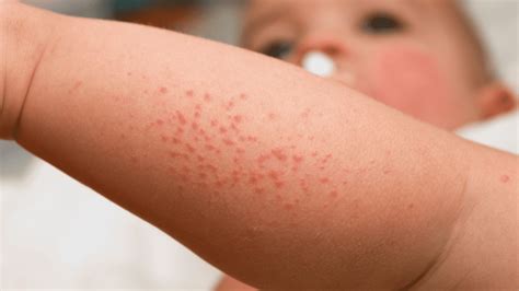 Irritação Na Pele Do Bebe - Alergias de pele em bebê: quais são as mais comuns?