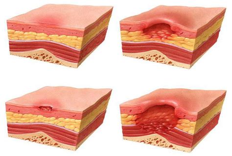 Coagulative necrosis: description, causes and treatment