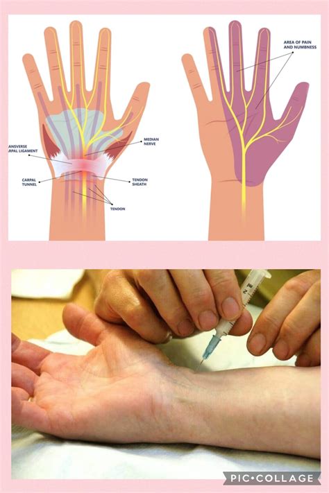 Carpal Tunnel Syndrome and Treatments