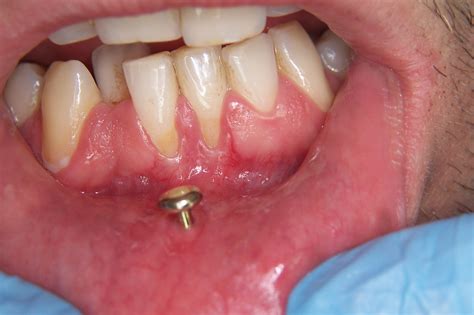 oral piercings = broken teeth...or worse! - Mead Family Dental