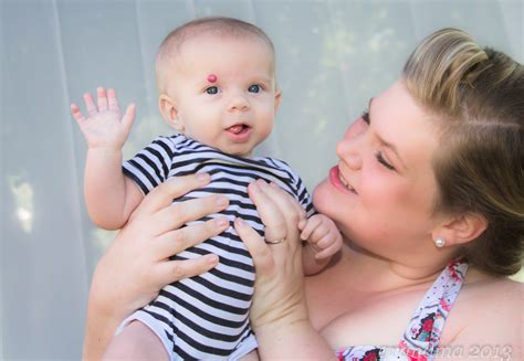 Stork Bite Nose