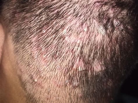 Folliculitis puss : r/Folliculitis
