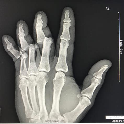 Never broke a bone : r/Neverbrokeabone