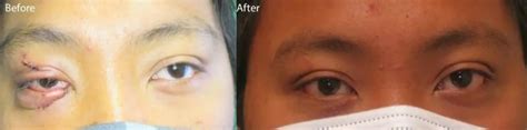 Eye Trauma Treatment in Phoenix, Arizona | Oculoplastic Eye Surgeons