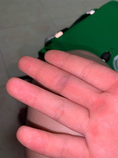 is this a bruise or internal bleeding : r/medical