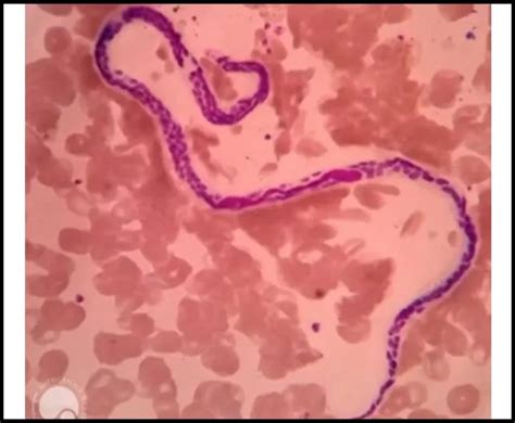 lymphatic filariasissdcindia