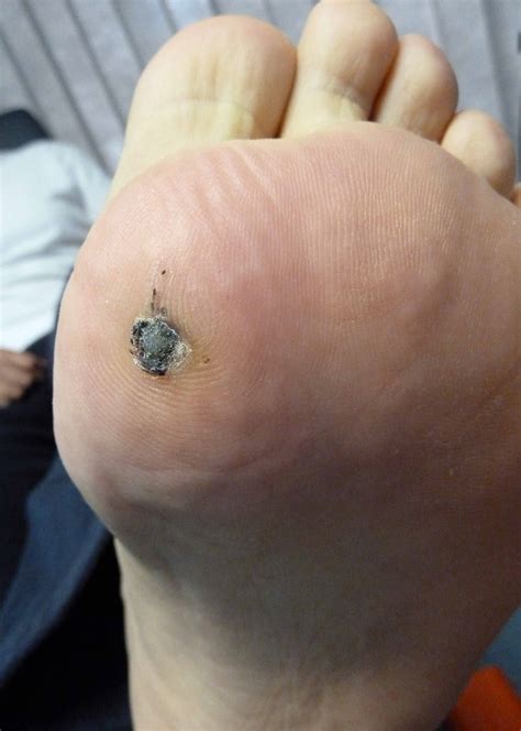 Plantar Warts Treatment Montreal at Ernest Stockton blog