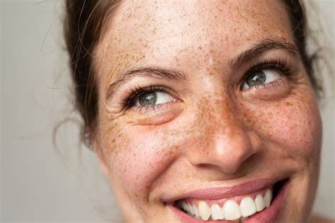 freckles concerns exeter skin southwest
