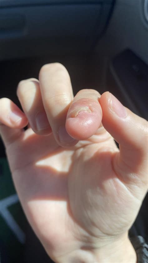 Can my deformed nail be restored to her glory? : r/lacqueristas