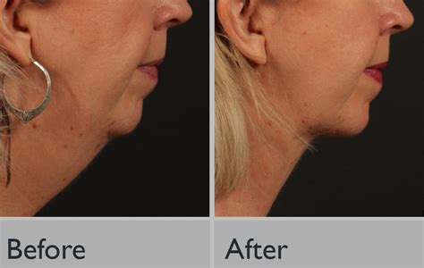 Transform Your Appearance: Quick Double Chin Reduction Techniques - Hunter Games Magazine
