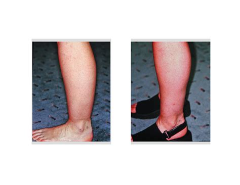 ankle-and-calf-liposuction-dr-barry-eppley-indianapolis - Explore