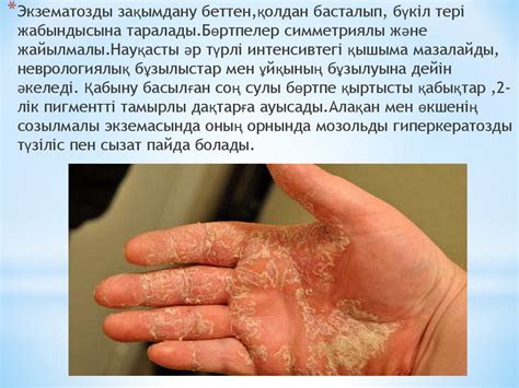 Экзема. Экземаның түрлері - online presentation