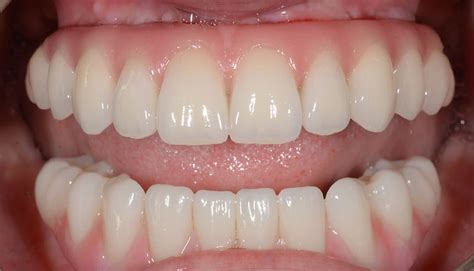 upper   fixed teeth cardiff dentalimplantswales