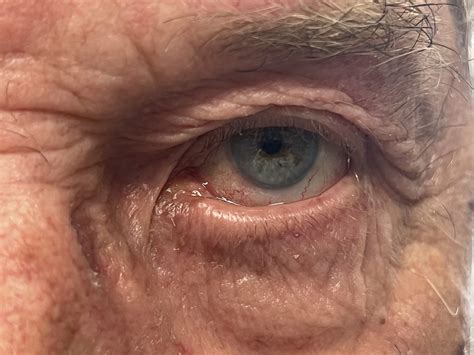 ectropion unveiled  eyelid malposition diagnosis  targeted