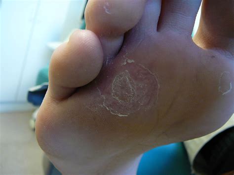 verruca plantaris - Advanced Foot And Ankle Center Of San Diego