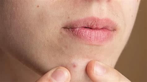 jerawat  sekitar bibir simak penyebab  mencegah  mengobati