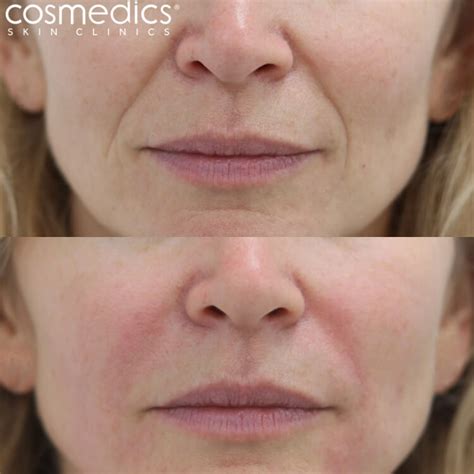 nasolabial folds nose  mouth fillers cosmedics skin clinics
