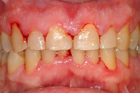 What Is Gingivitis What Causes Gingivitis Roy Morris - vrogue.co