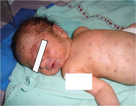 Muffin Baby Rash at Cooper Meares blog