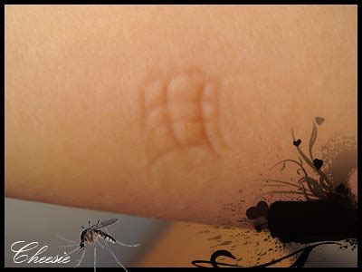 What do you do to a mozzie bite? | Cheeserland