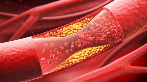 artery disease treatments stridecare