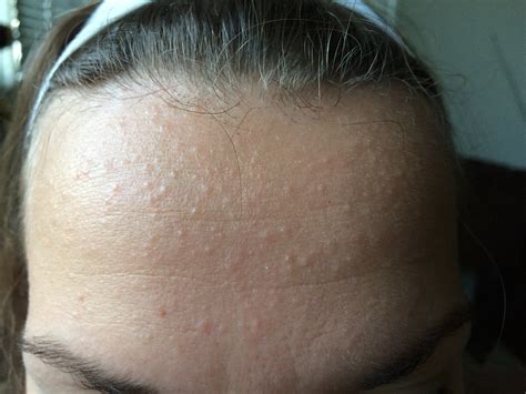 What Is Itchy Bumps On Skin at Lilly Hoover blog