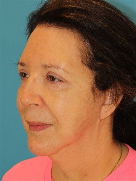 Face & Neck Lift Before & After in Houston, TX | Face Forward