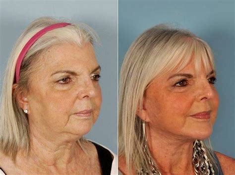 Atlanta Facelift Surgery » Facelift: Info, Prices, Photos, Reviews, Q&A ...