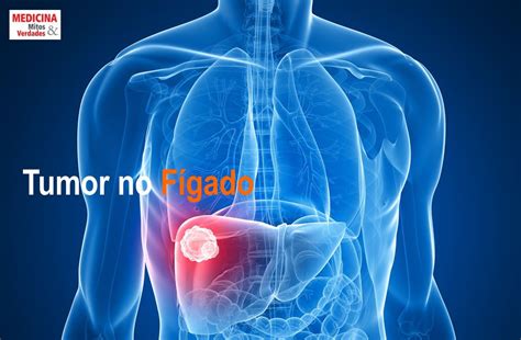 O Que Causa Cancer No Figado - Causas e sintomas do câncer de fígado | Medicina - Mitos e Verdades