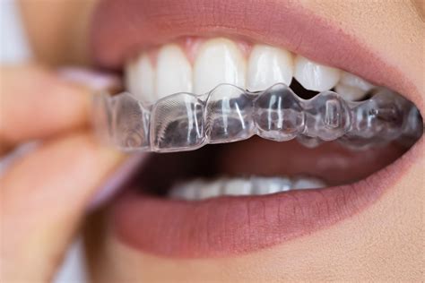 A Custom Guard Can Relieve TMD Symptoms | El Paso, TX