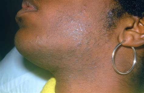 imagepseudofolliculitis barbae msd manual consumer version