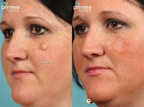 Cyst Removal Before and After Pictures Case 468 | Orlando, Winter Park ...