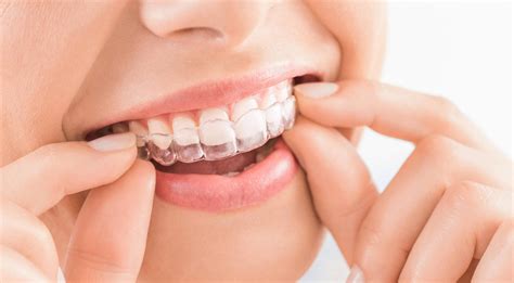invisalign treatment  kochi clear aligners dental point