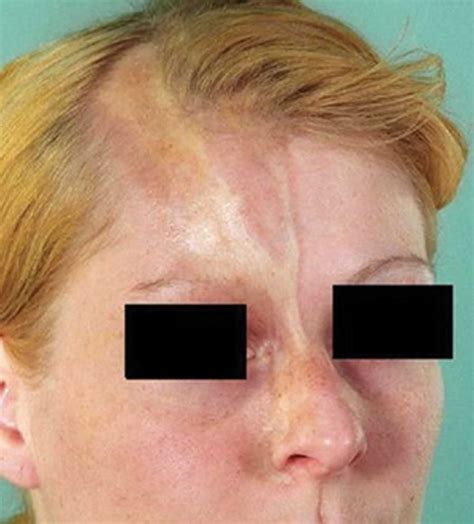 linear scleroderma  symptoms diagnosis treatment prognosis