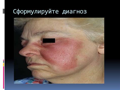 Рожа. Возбудитель рожи - презентация онлайн