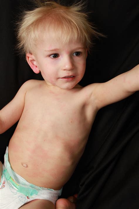 Rash Christmas Tree
