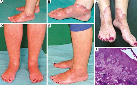 Necrolytic Acral Erythema