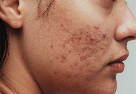 acne face map     breakouts acne map body acne