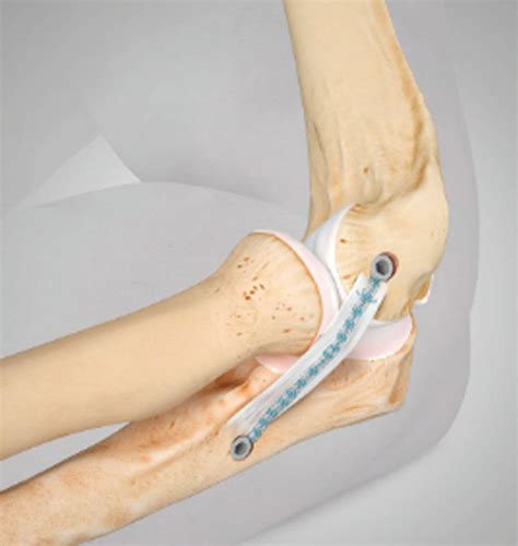 Lateral Ulnar Collateral Ligament