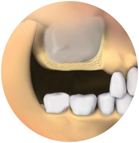 patient sinus liftsbone grafts southern implants
