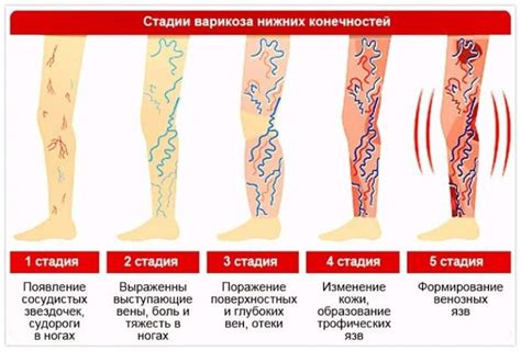 Что полезно при варикозе: 14 рецептов для здоровья вен