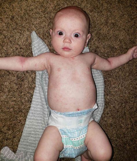 Measles Symptoms In Toddlers