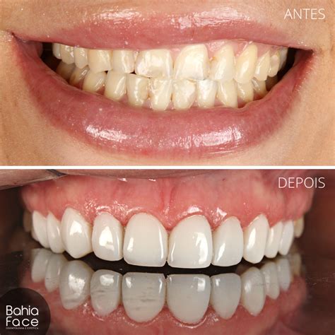Faceta De Resina Antes E Depois - [Serviço] Faceta de resina