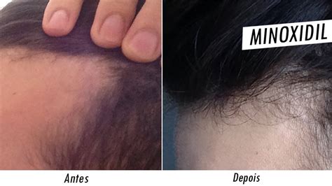 Minoxidil Funciona? Minoxidil Cabelo Como Usar? - Tira Dúvidas Online