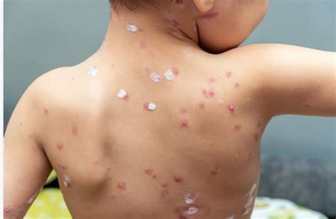 kenali berbagai jnis jenis cacar beritalimacom