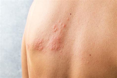 Shingles: What you need to know - Flourish