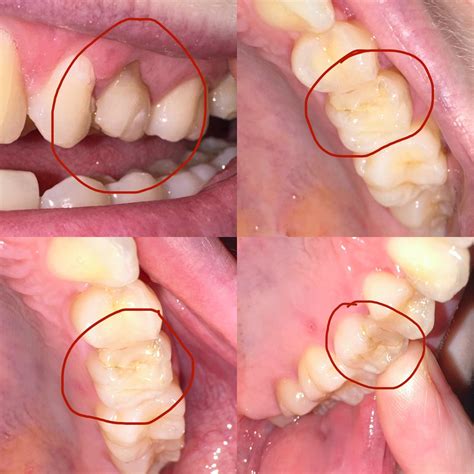 Increased sensitivity after a molar filling, what is wrong with my