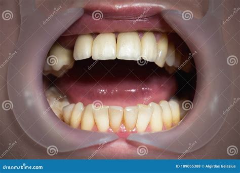 Mouth with Four Prosthetic Upper Teeth Stock Photo - Image of ...