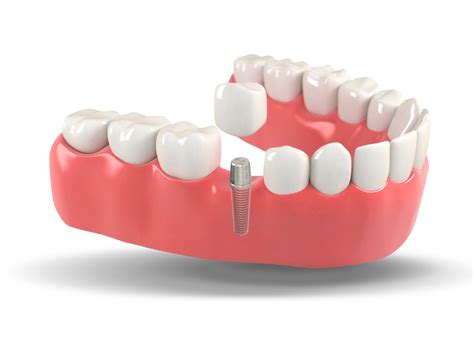 dental implants    dental implants cosmetic dentistry