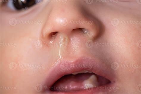 Yellow snot from a child s nose, close-up. Sinus infections, colds and